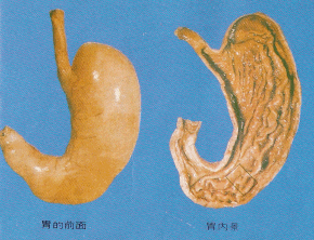 胃潰瘍
